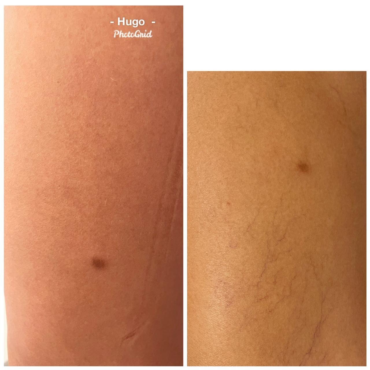 Resultado de tratamento vascular 1