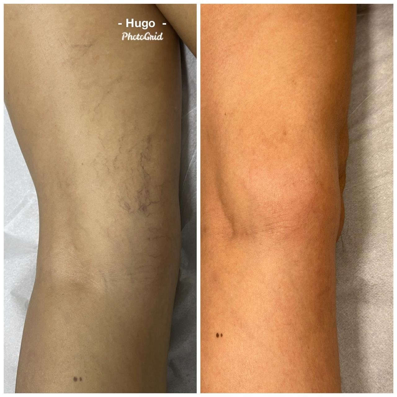 Resultado de tratamento vascular 2