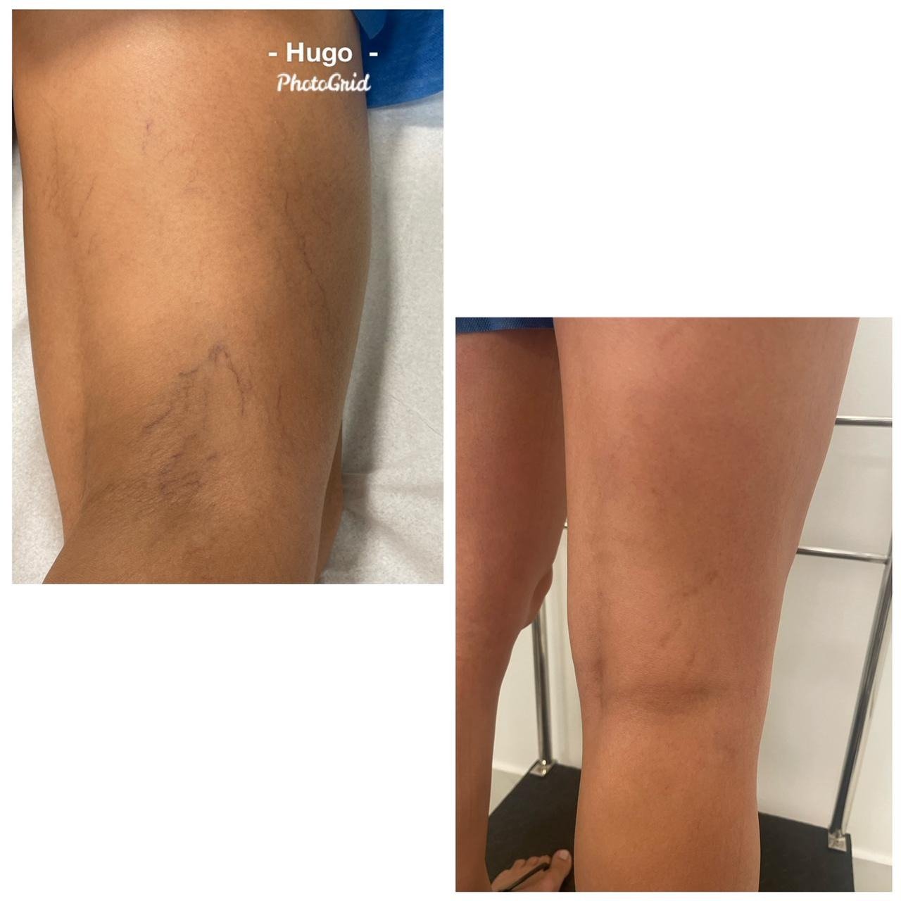Resultado de tratamento vascular 7