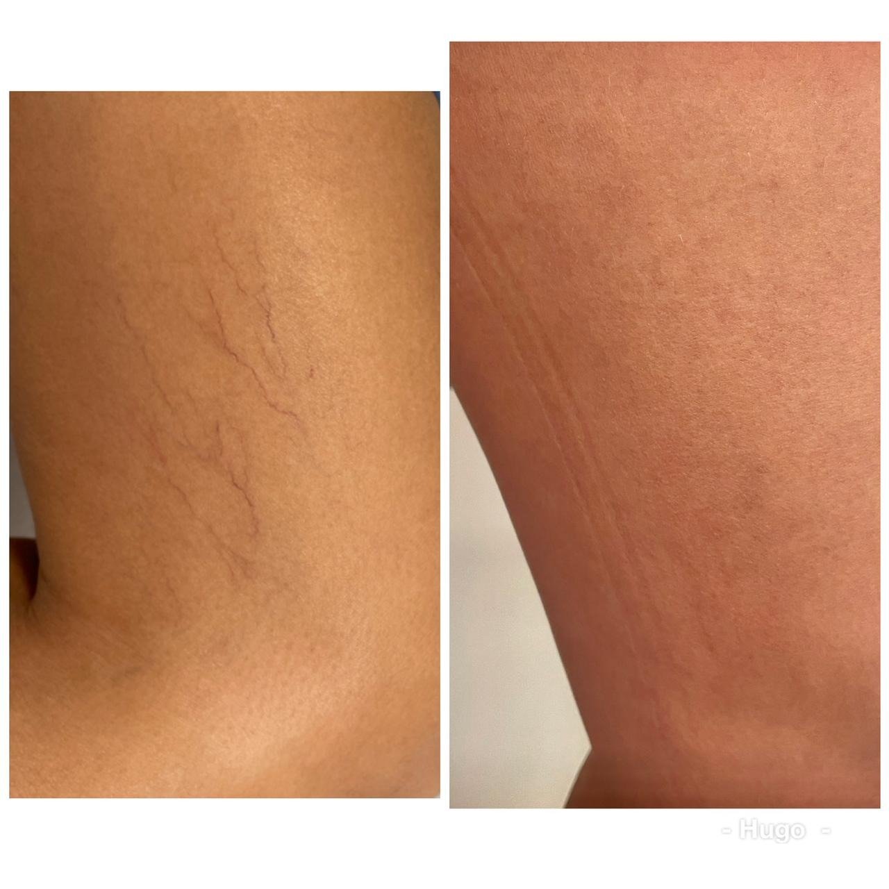 Resultado de tratamento vascular 8