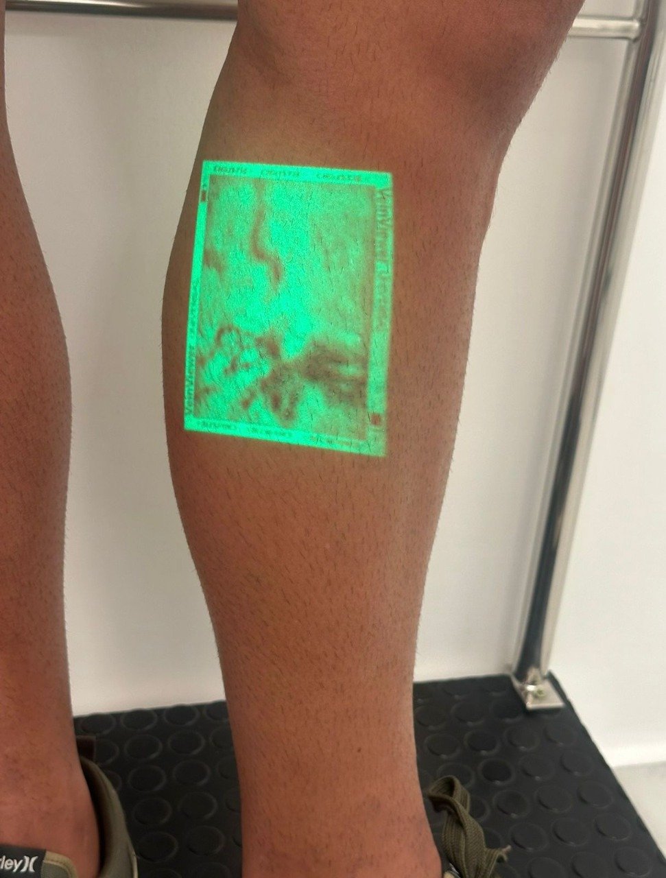 Projeção de veias com VeinViewer